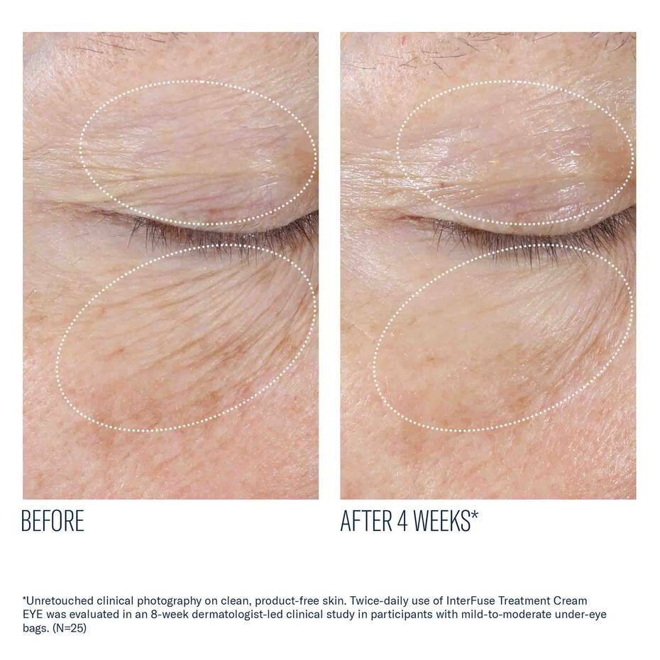 Skinbetter Interfuse Treatment Cream Eye (0.5 fl oz)