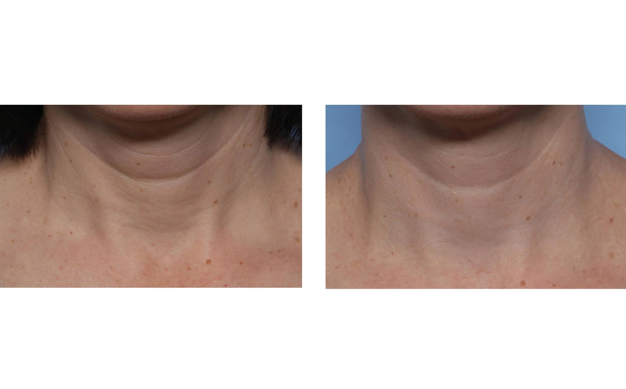 Skinbetter Techno Neck Perfecting Cream (1.7 fl oz)
