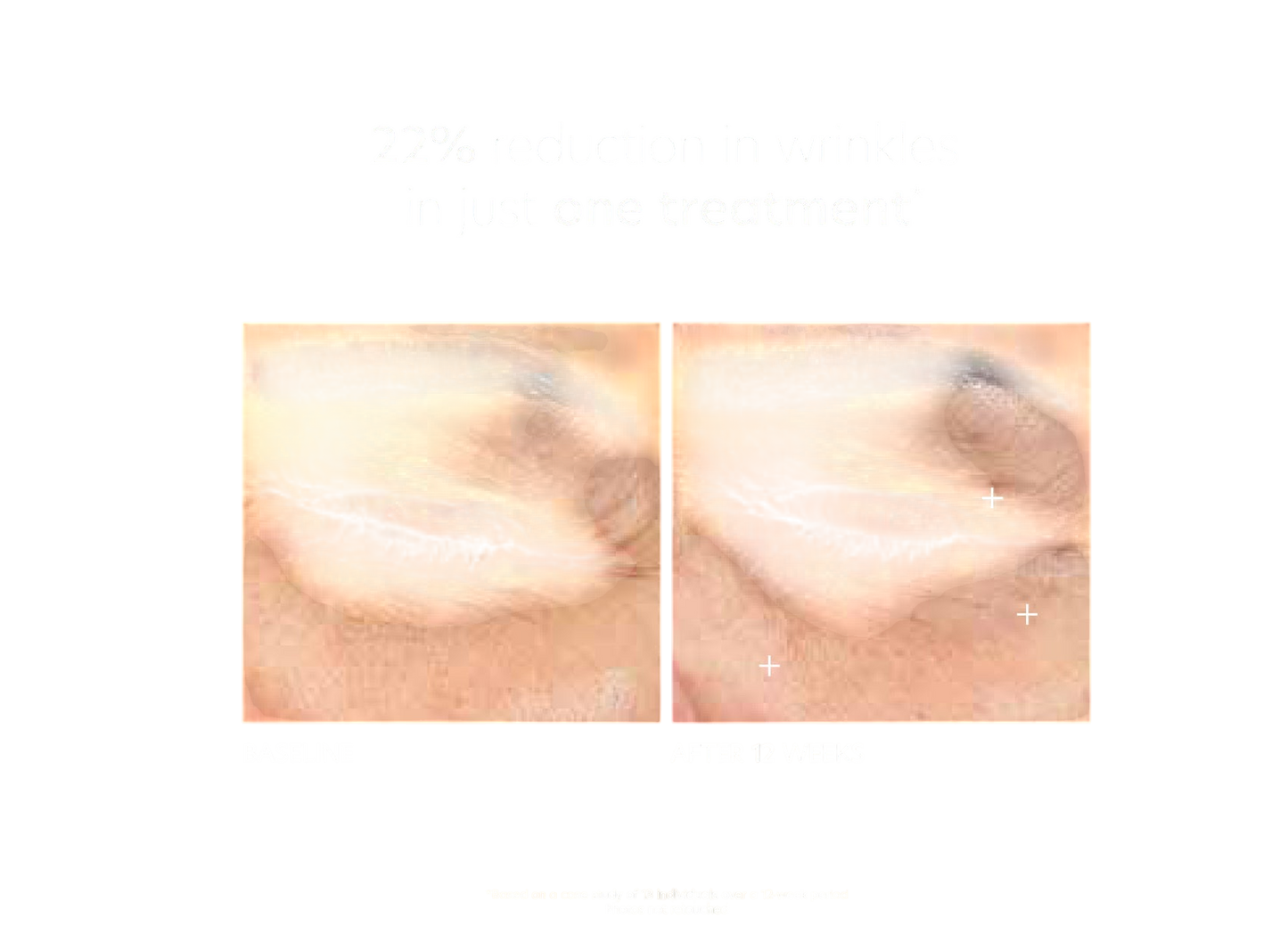 Pca Skin Hyaluronic Acid Microneedle Eye Patches