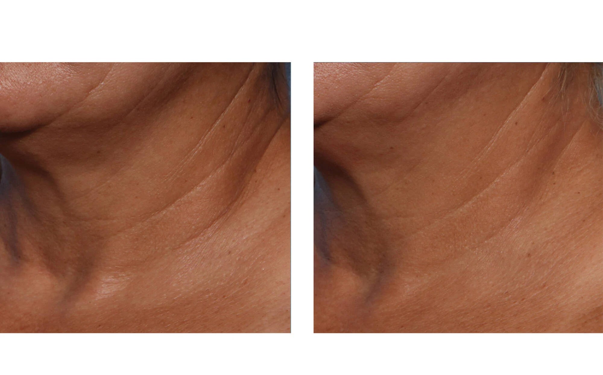 Skinbetter Techno Neck Perfecting Cream (1.7 fl oz)