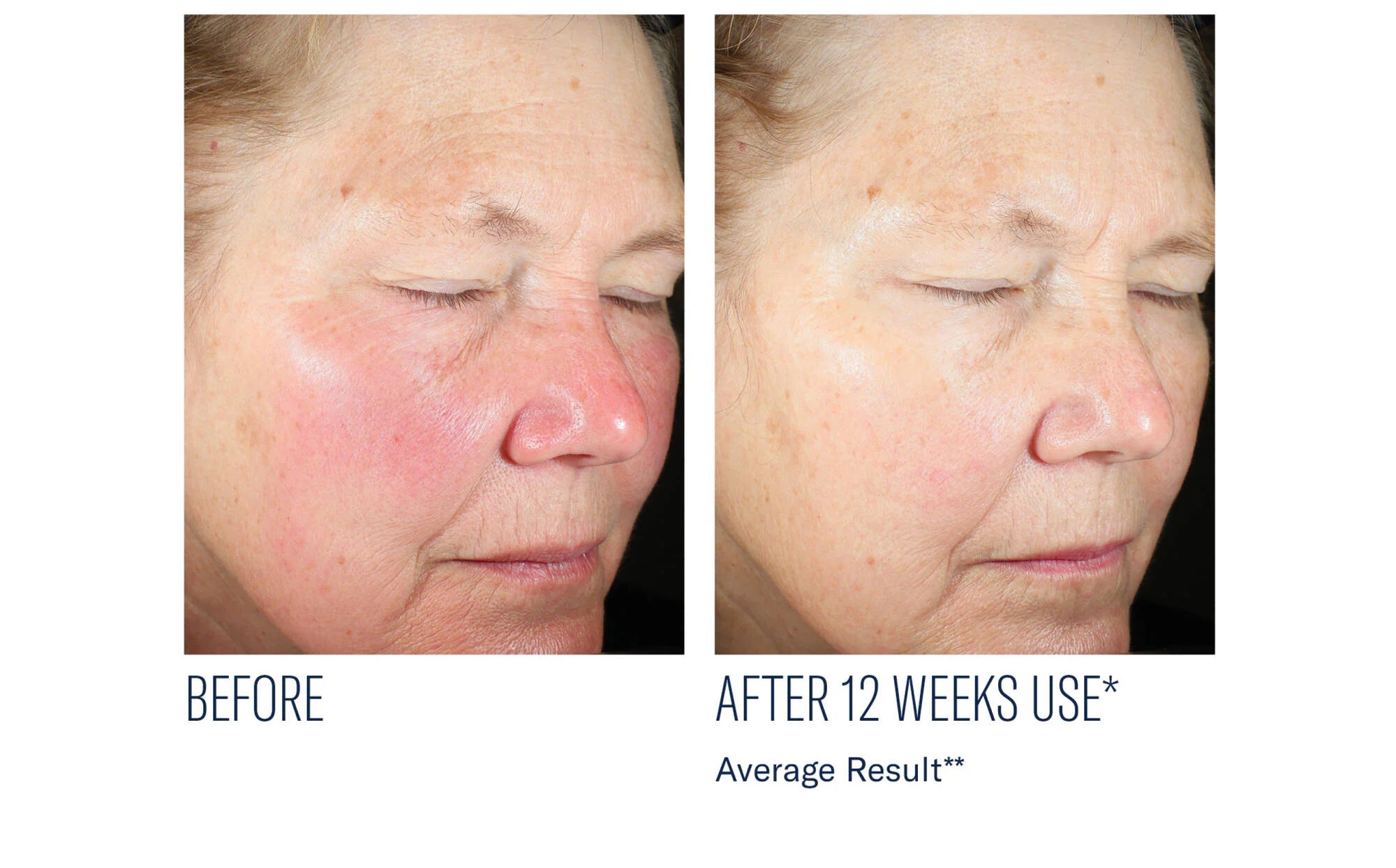Skinbetter Even Intensive Skin Tone Correcting Serum (1.7 fl oz)