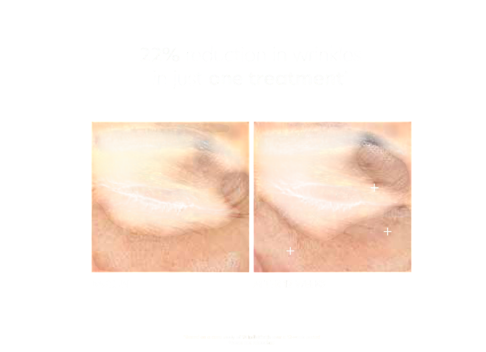 Pca Skin Hyaluronic Acid Microneedle Eye Patches