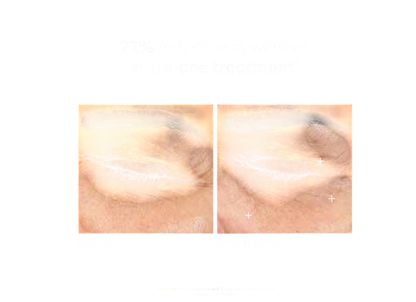 Pca Skin Hyaluronic Acid Microneedle Eye Patches